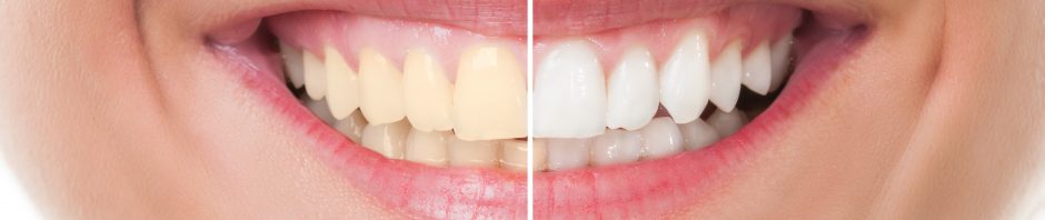 teeth whitening alhambra ca