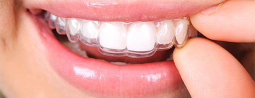 Invisalign