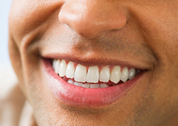 Dental Crowns in Alhambra